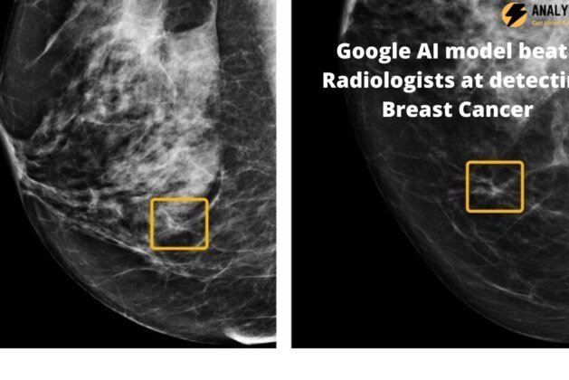 Google AI Model Detects Breast Cancer more accurately than Radiologists